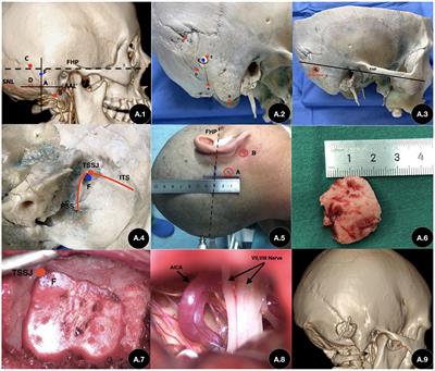 Precise Localization in Craniotomy With a Retrosigmoid Keyhole Approach: Microsurgical Anatomy and Clinical Study